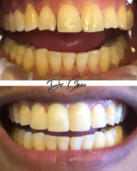 Aesthetic bonding – Dr Michael Chu
