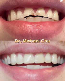 Composite bonding in 60 minutes – Dr Michael Chu