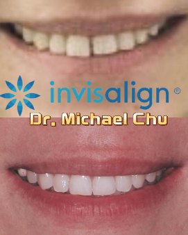 Invisalign gap closure – Dr Michael Chu