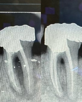 Root canal – 1 year review – Dr Michael Chu