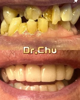Full smile restoration – Dr Michael Chu