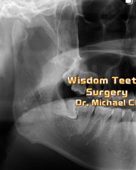 Impacted lower wisdom tooth – Dr Michael Chu