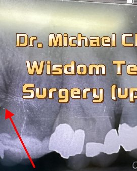 Upper wisdom tooth surgery – Dr Michael Chu